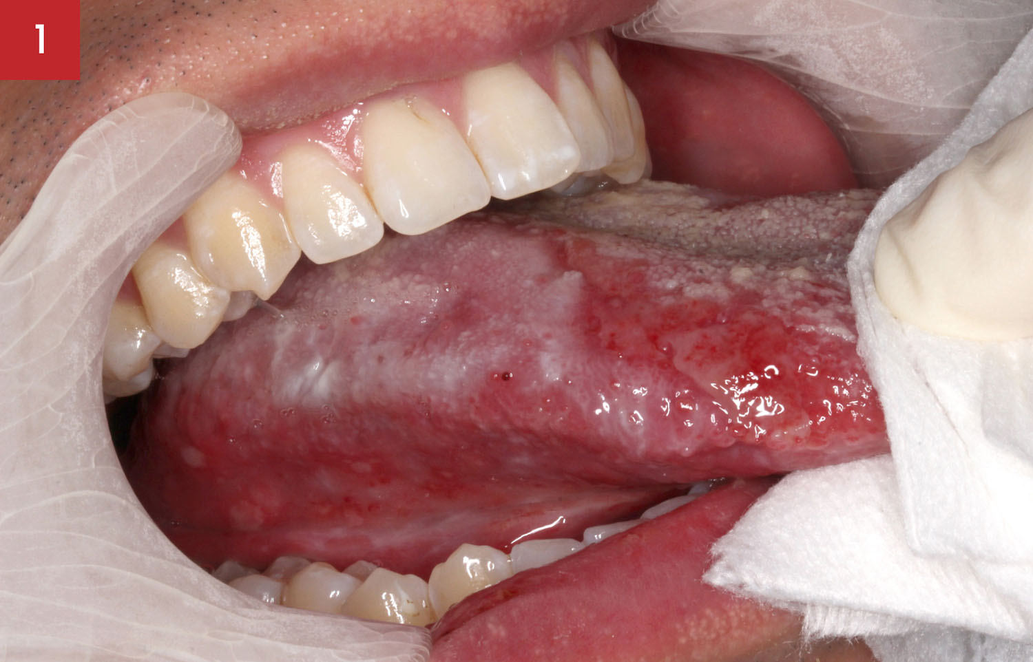 tongue lichenoid mucositis