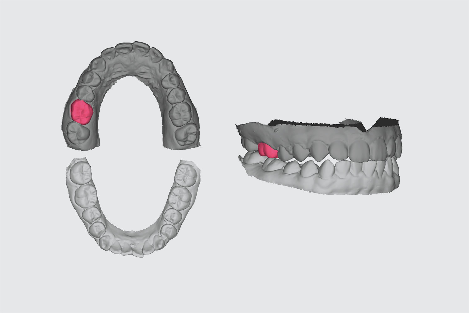 AI Technology to Automate the Process of Denture Design