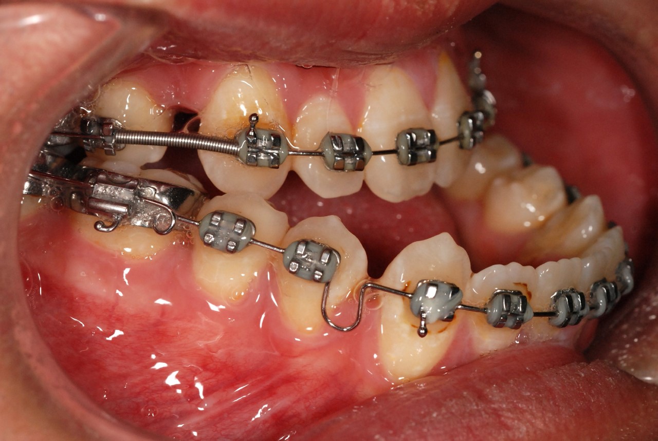 HKU Faculty of Dentistry, Oral and Maxillofacial Study Shows Internal Fixation Surgery Linked with Improvement in Long Jaw Patients’ Quality of Life