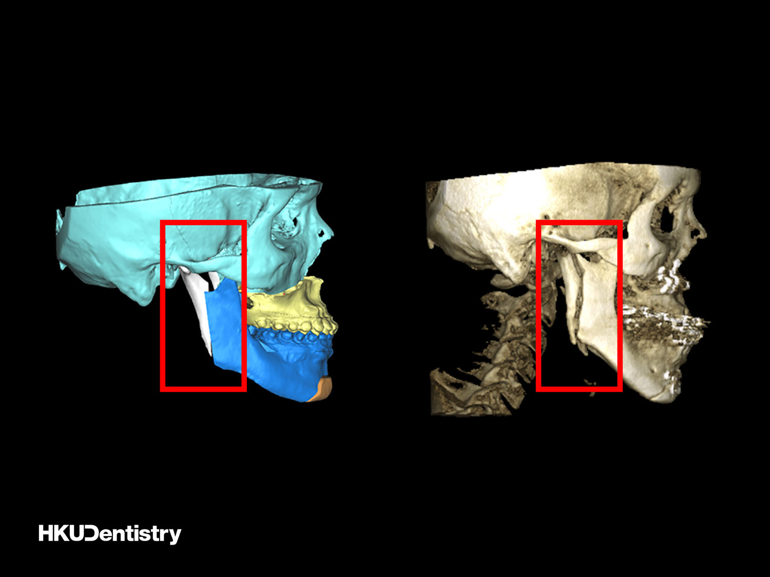 HKU Faculty of Dentistry, Oral and Maxillofacial Study Shows Internal Fixation Surgery Linked with Improvement in Long Jaw Patients’ Quality of Life