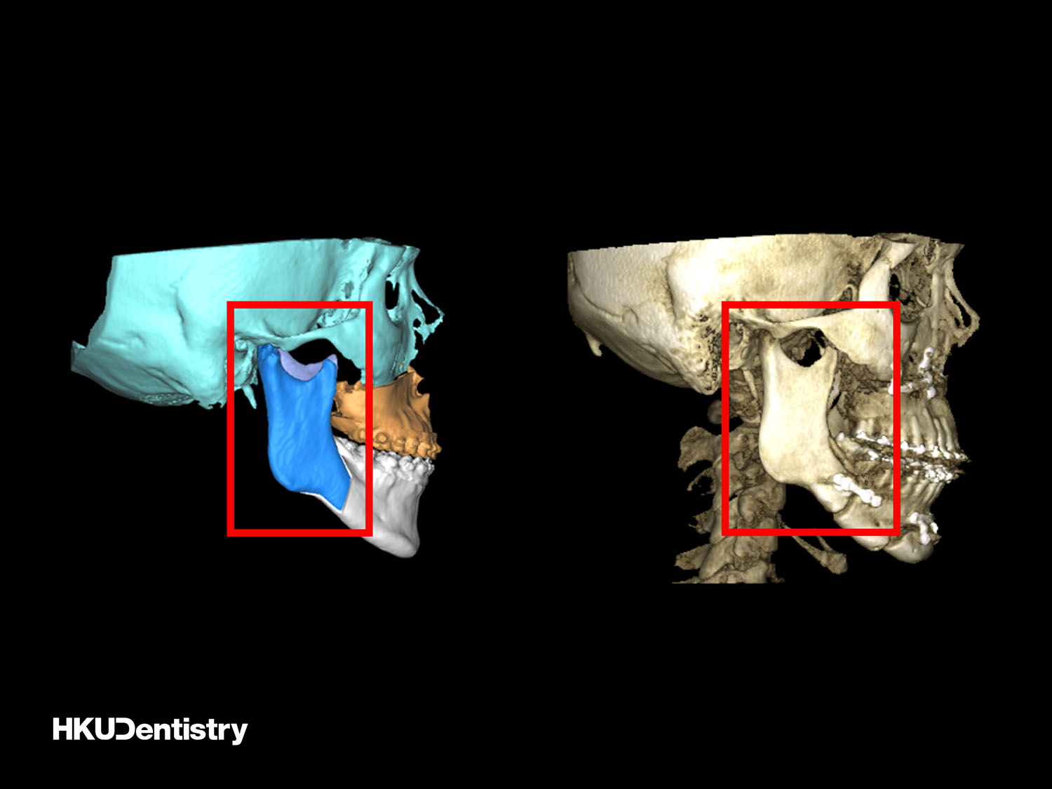 HKU Faculty of Dentistry, Oral and Maxillofacial Study Shows Internal Fixation Surgery Linked with Improvement in Long Jaw Patients’ Quality of Life