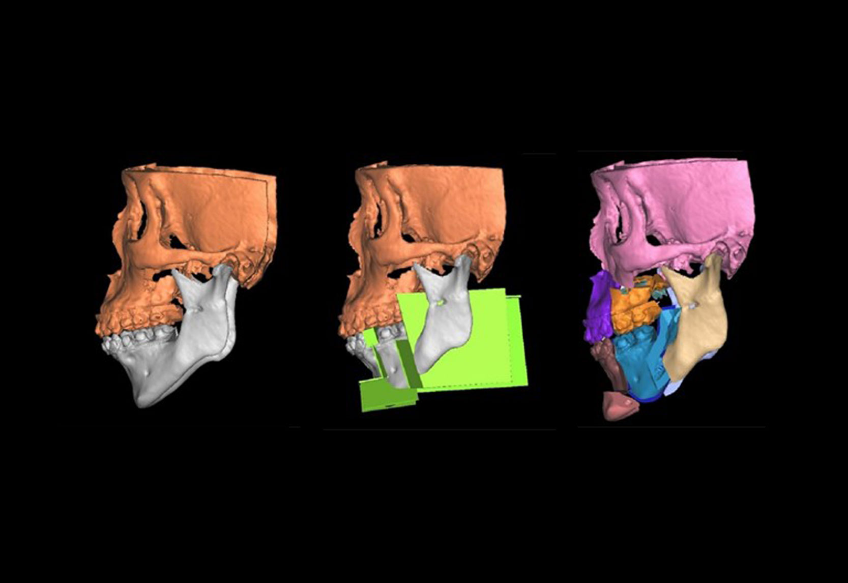 3D surgical planning of the SMA