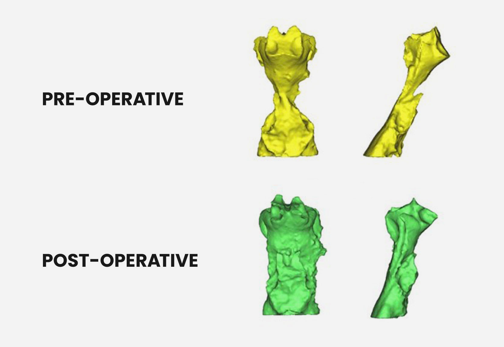 The pre-operative and post-operative airway images
